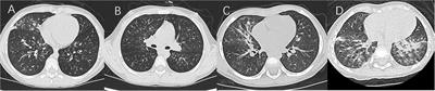 Clinical features and “early” corticosteroid treatment outcome of pediatric mycoplasma pneumoniae pneumonia